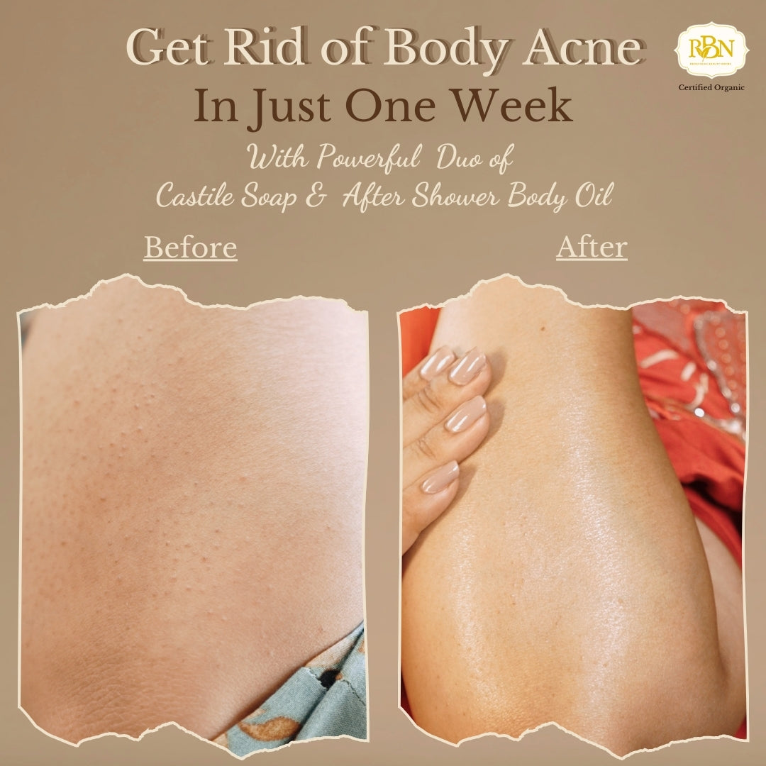 Get Rid of Body Acne Combo